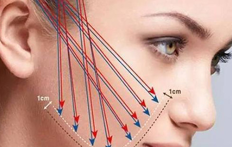 脸部线雕注意事项汇总 线雕后正确养护提升效果